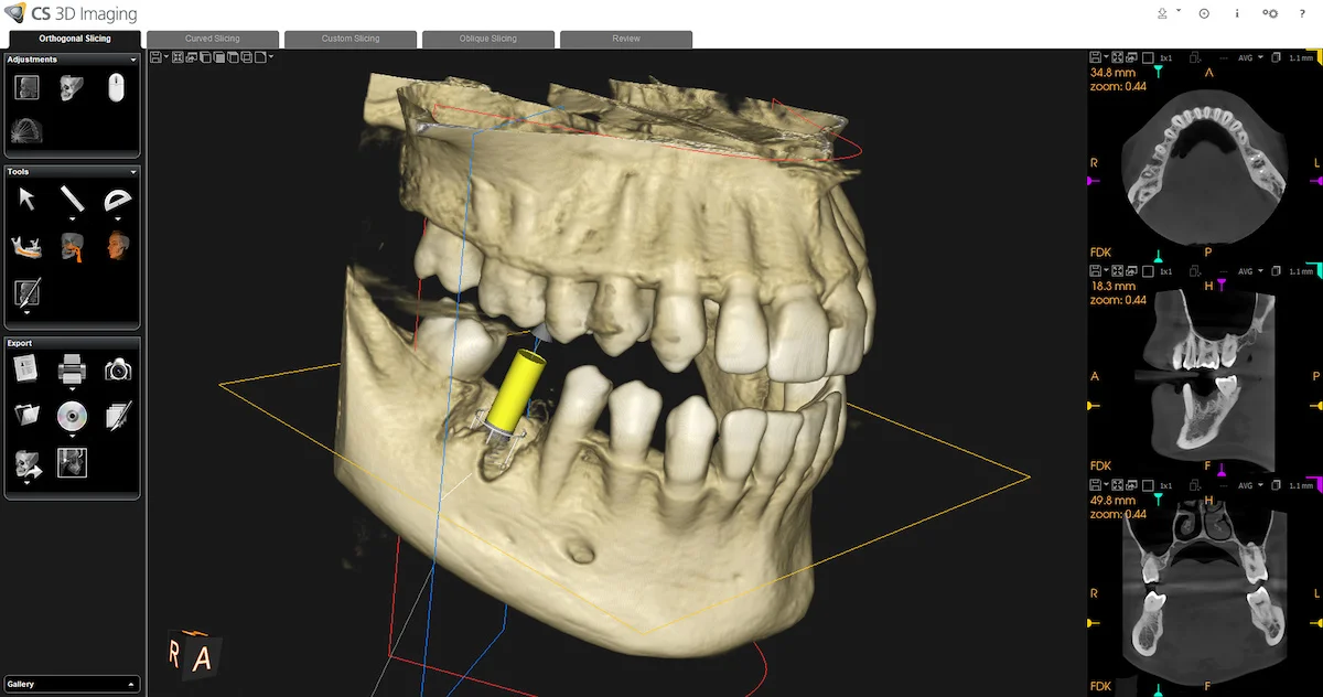 CTによるあごの骨と歯の3D画像診断