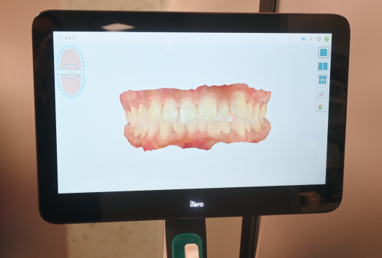 噛み合わせの3Dスキャナー結果が表示されているモニター