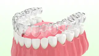 マウスピース矯正の症例
